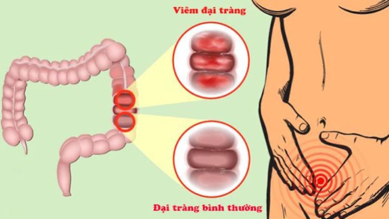 Chẩn đoán viêm đại tràng thường cần kết hợp nhiều phương pháp để xác định nguyên nhân và mức độ bệnh