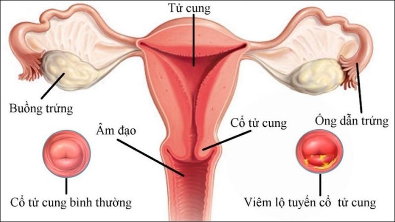 Viêm cổ tử cung là tình trạng viêm nhiễm, sưng tấy ở cổ tử cung do nhiều nguyên nhân gây ra