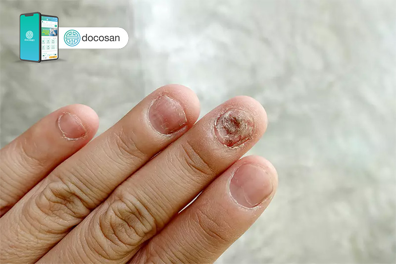 Nấm móng tay: Hiểu rõ hơn về tình trạng nấm móng tay và cách điều trị. Cảm nhận sự thư giãn tuyệt vời sau khi được làm sạch và khỏe mạnh bàn tay của bạn.