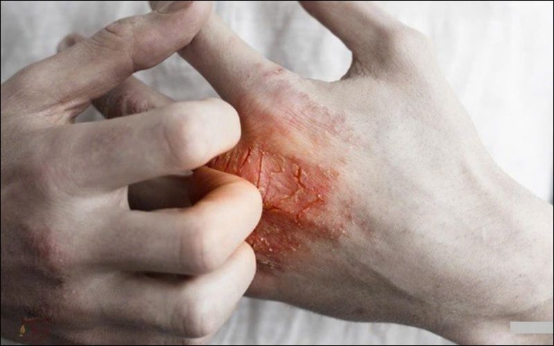 Chà xát và gãi làm tình trạng Eczema nặng thêm