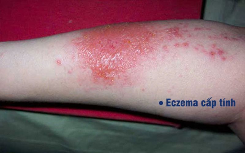 Eczema cấp tính