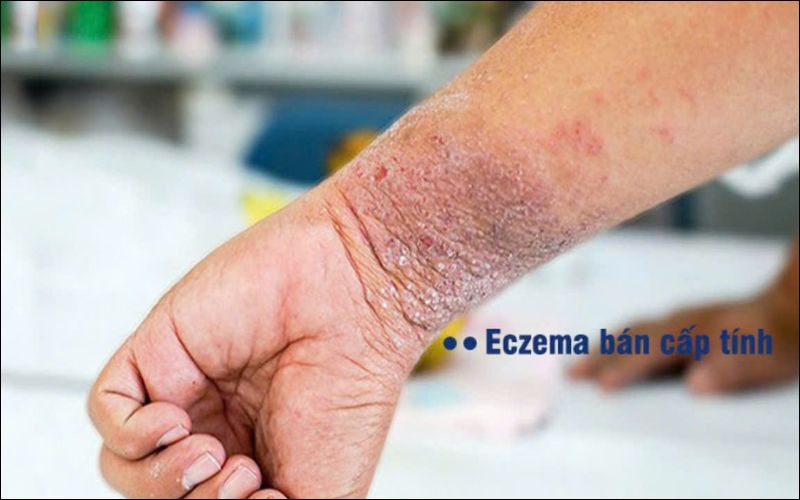 Eczema bán cấp tính