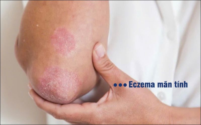 Eczema mãn tính