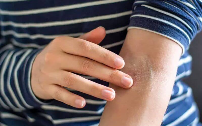 Dưỡng ẩm da thường xuyên để phòng ngừa Eczema