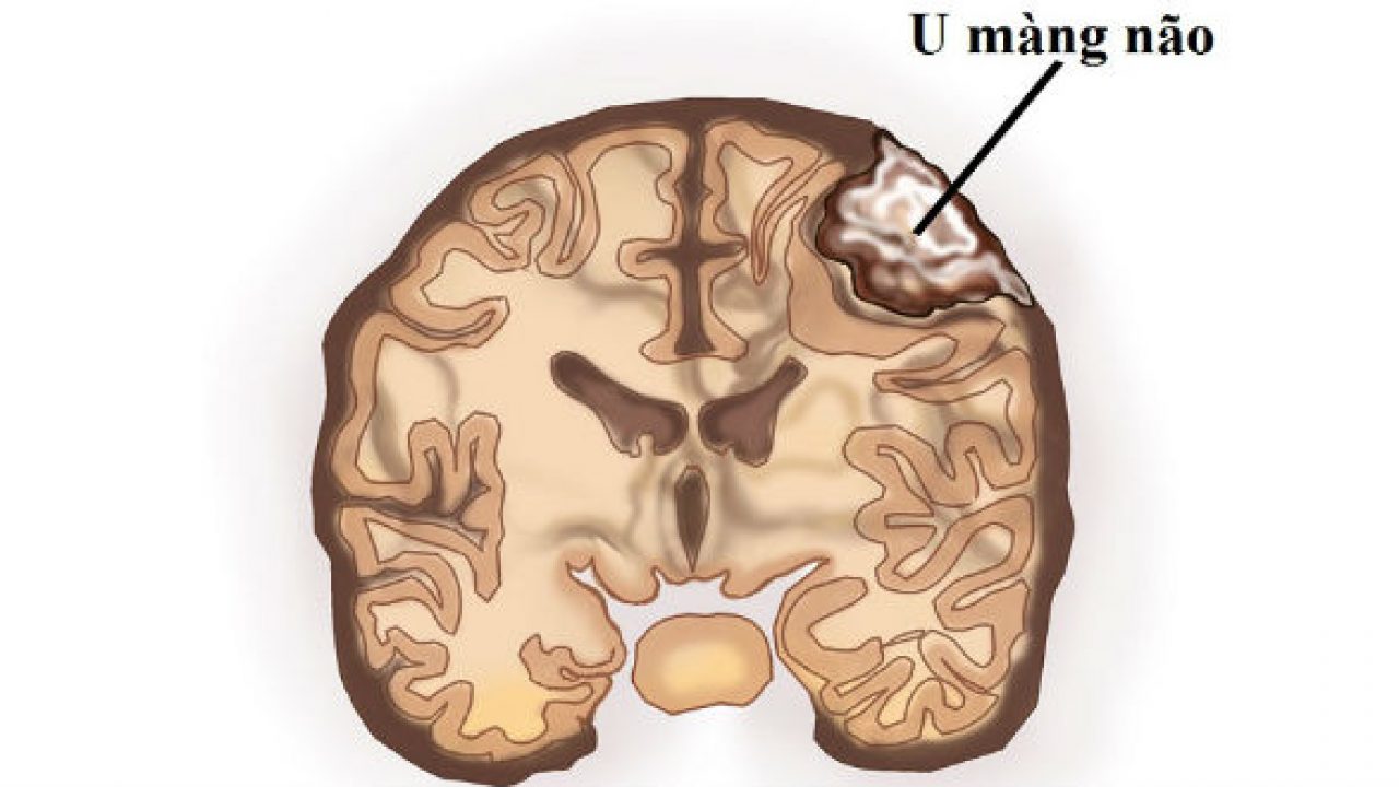 khối u màng não