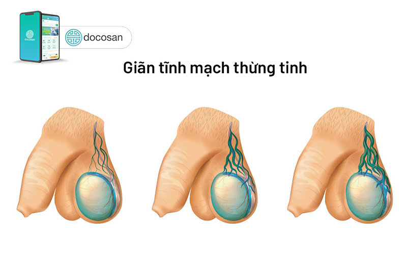 Giãn tĩnh mạch thừng tinh: Nguyên nhân và cách điều trị - Docosan