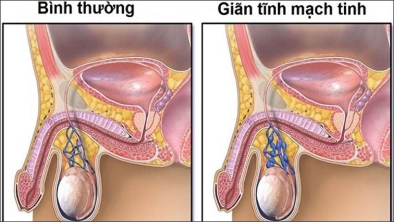 Giãn tĩnh mạch thừng tinh là nguyên nhân phổ biến nhất gây hiện tượng tinh trùng yếu