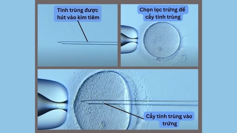 Các công nghệ hỗ trợ sinh sản có thể giúp nam giới bị tinh trùng yếu có con