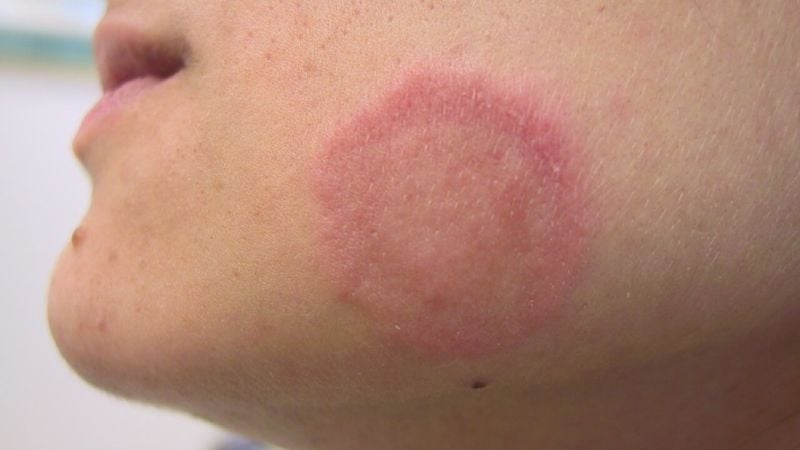 Hắc lào là một bệnh da liễu thường gặp, gây ra bởi nhiễm vi nấm Dermatophytes