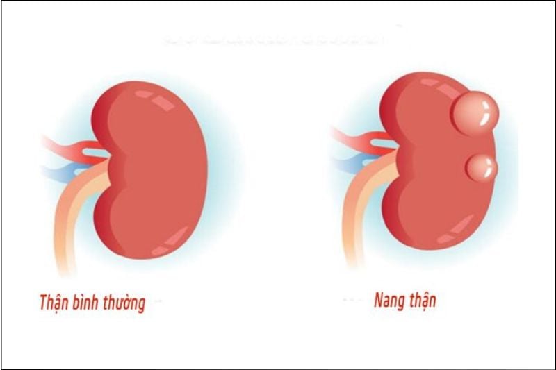 Hình ảnh minh họa về nang thận