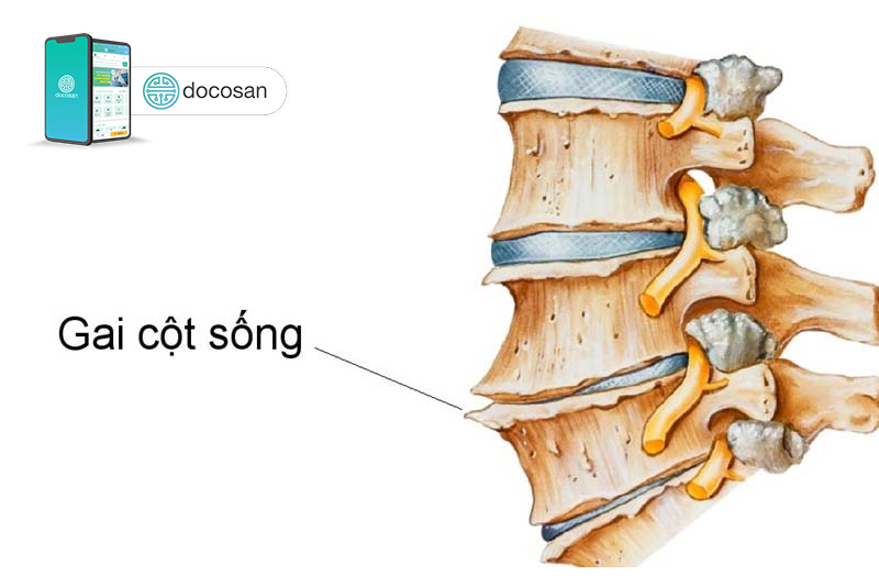 Gai cột sống: Nguyên nhân, chẩn đoán và điều trị - Docosan