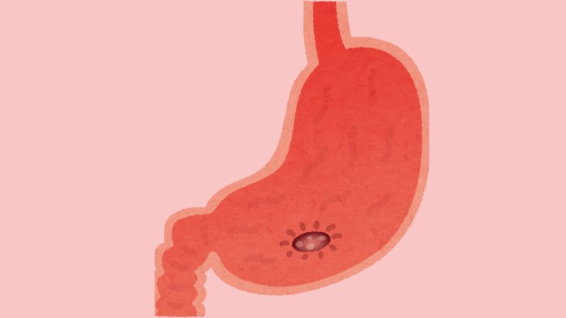 Polyp dạ dày có thể gây nên các triệu chứng như đau dạ dày, buồn nôn hoặc nôn