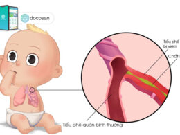 viêm tiểu phế quản ở trẻ sơ sinh
