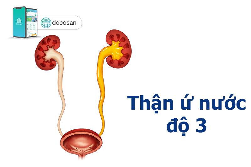 8. Phương pháp điều trị thận ứ nước độ 3