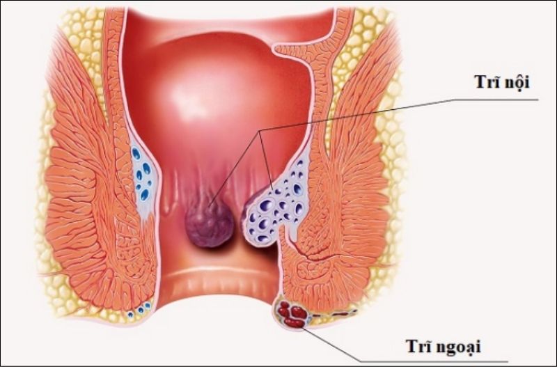 Trĩ là nguyên nhân phổ biến gây ra tình trạng tiêu phân máu