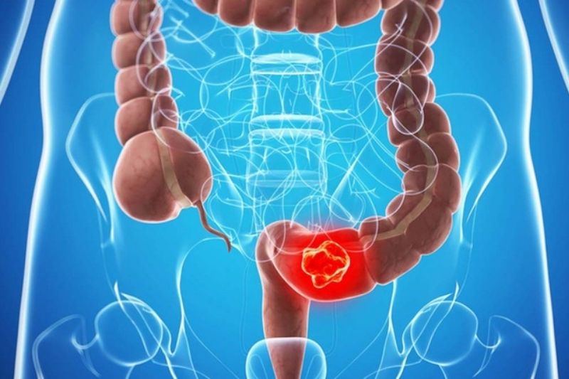 Đi vệ sinh ra máu tươi kéo dài có thể là dấu hiệu ung thư đại tràng