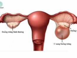 Các triệu chứng của u nang buồng trứng
