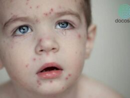 triệu chứng thuỷ đậu ở trẻ nhỏ