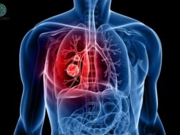 Dấu hiệu ung thư phổi