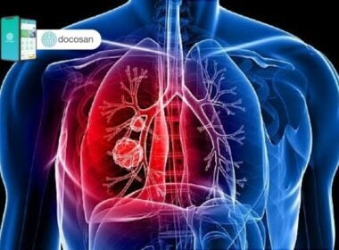 Dấu hiệu ung thư phổi ở nam giới