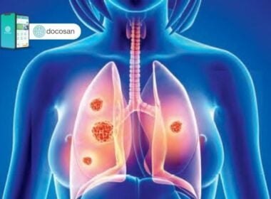 Dấu hiệu ung thư phổi ở nữ giới