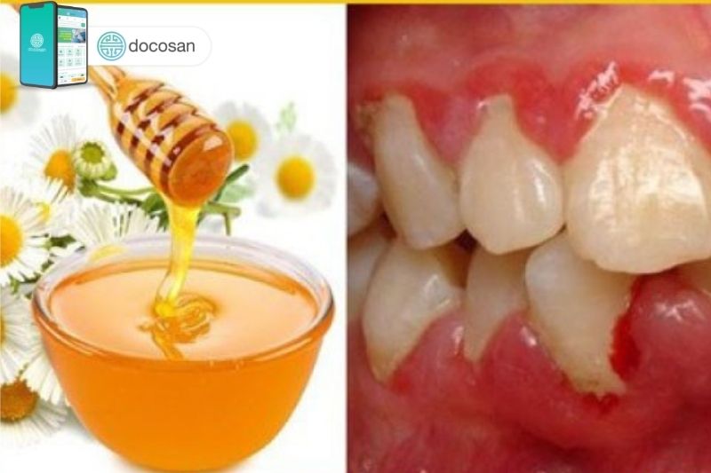 7 cách chữa viêm nướu răng dân gian