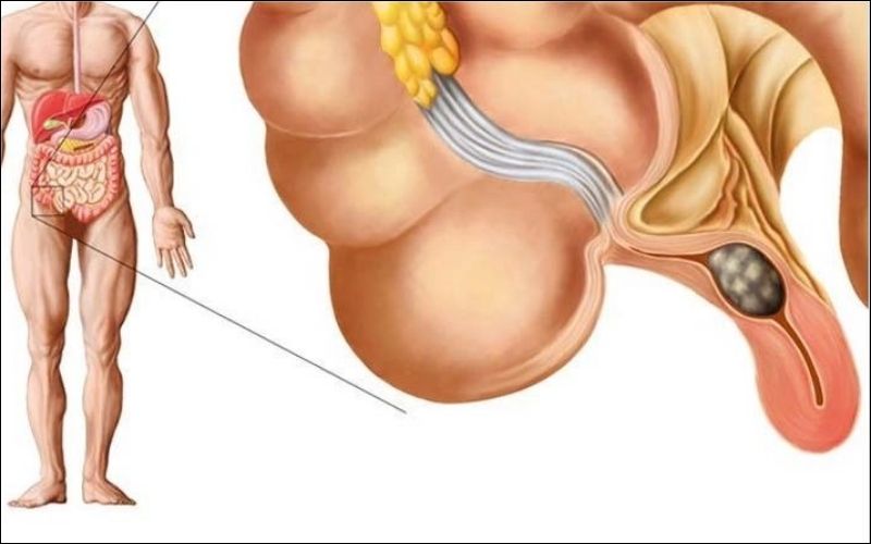 Sỏi phân kẹt trong ruột thừa là một trong những nguyên nhân phổ biến nhất gây viêm ruột thừa