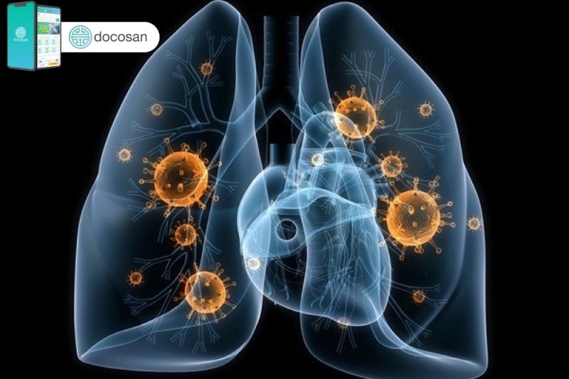 Ung thư phổi có di truyền hay không