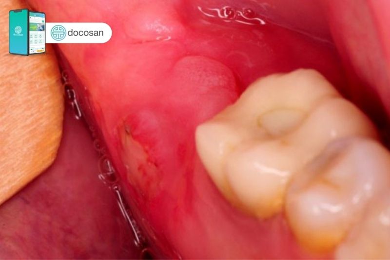Lưu ý về sưng nướu răng trong cùng hàm dưới mà bạn cần biết