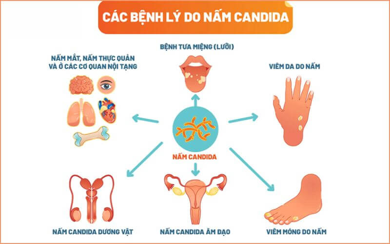 Nhiễm nấm Candida có thể xuất hiện ở nhiều vị trí trên cơ thể