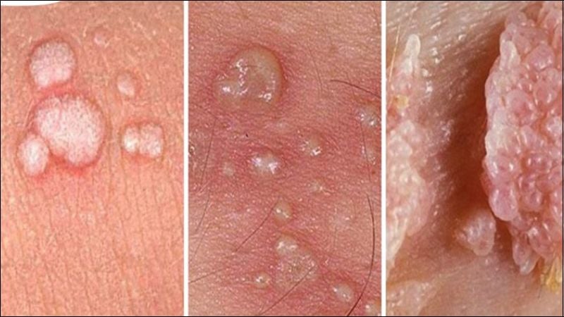 Sùi mào gà là một bệnh lây truyền qua đường tình dục do một số chủng virus HPV gây ra