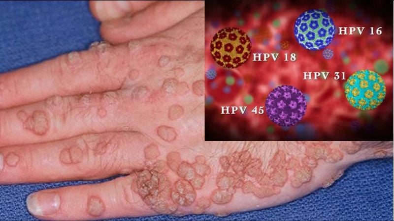 Sùi mào gà do virus HPV (Human Papillomavirus) gây ra bệnh ở vùng sinh dục