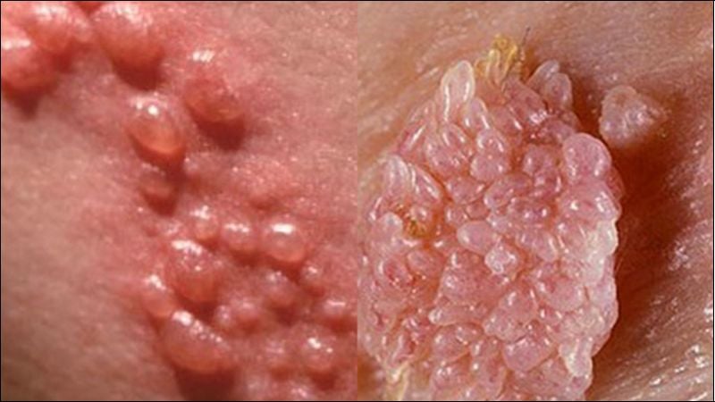 Sùi mào gà có thể được điều trị và loại bỏ nhưng virus HPV không thể bị tiêu diệt hoàn toàn