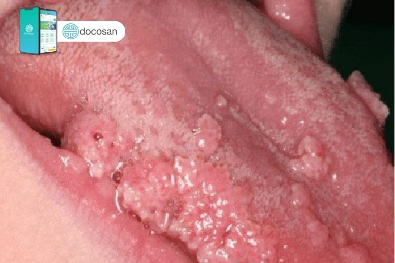Bệnh sùi mào gà ở lưỡi: Nguyên nhân và cách điều trị – Docosan