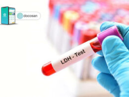 xét nghiệm LDH
