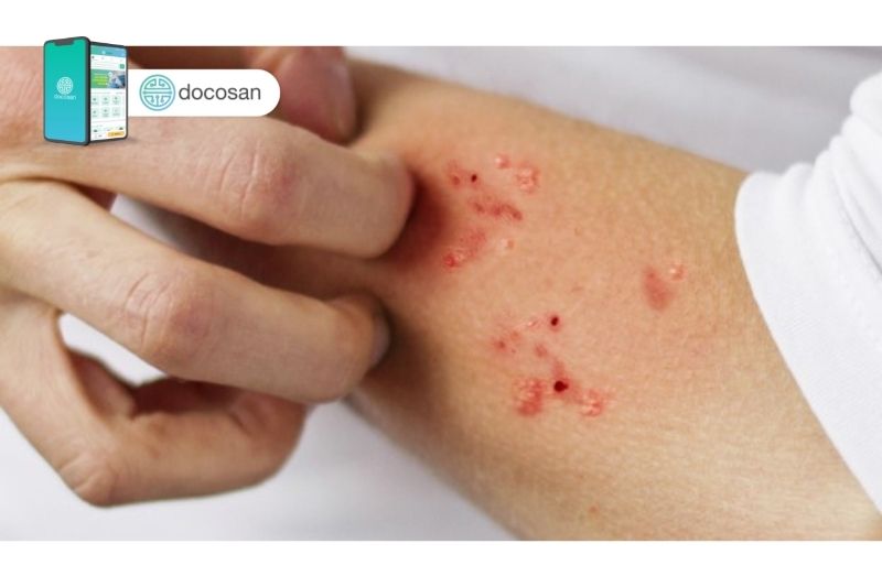 Ghẻ ruồi: Triệu chứng nhận biết và cách điều trị hiệu quả - Docosan