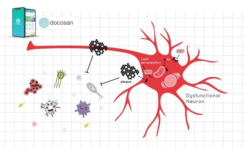 cách chữa bệnh Alzheimer