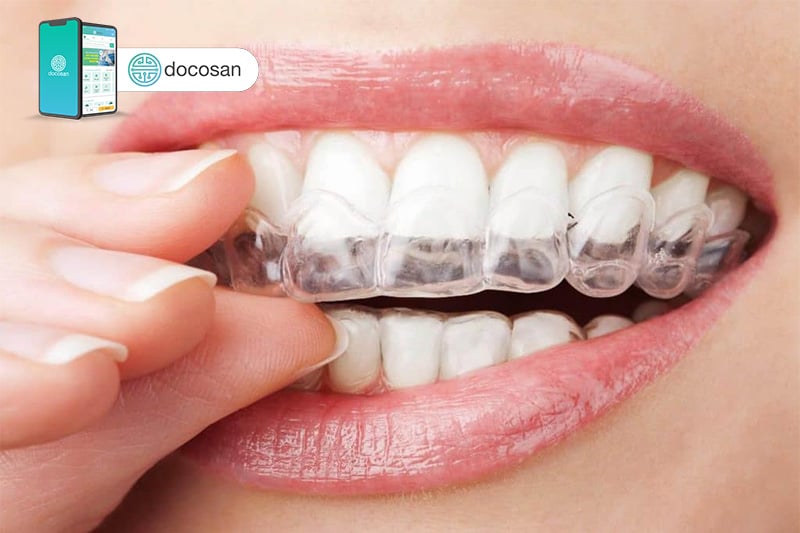 niềng răng invisalign