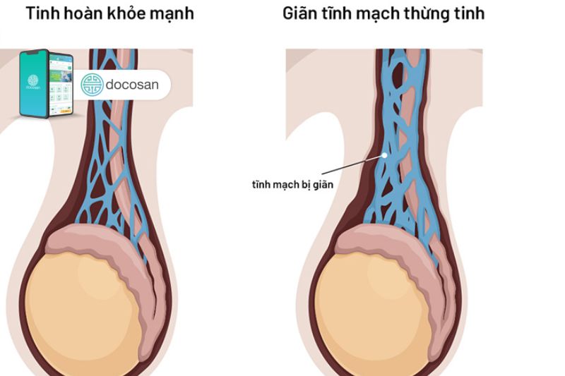 Giãn tĩnh mạch thừng tinh trái: Chẩn đoán và cách điều trị - Docosan