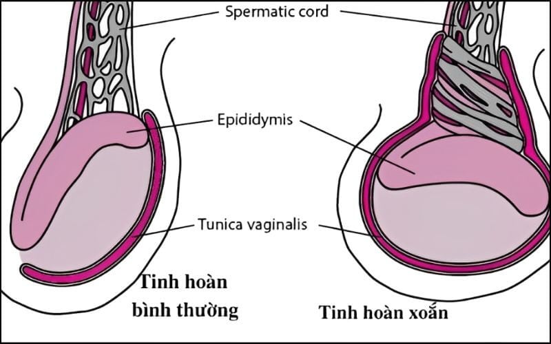 Xoắn tinh hoàn là trường hợp khẩn cấp cần phẫu thuật ngay