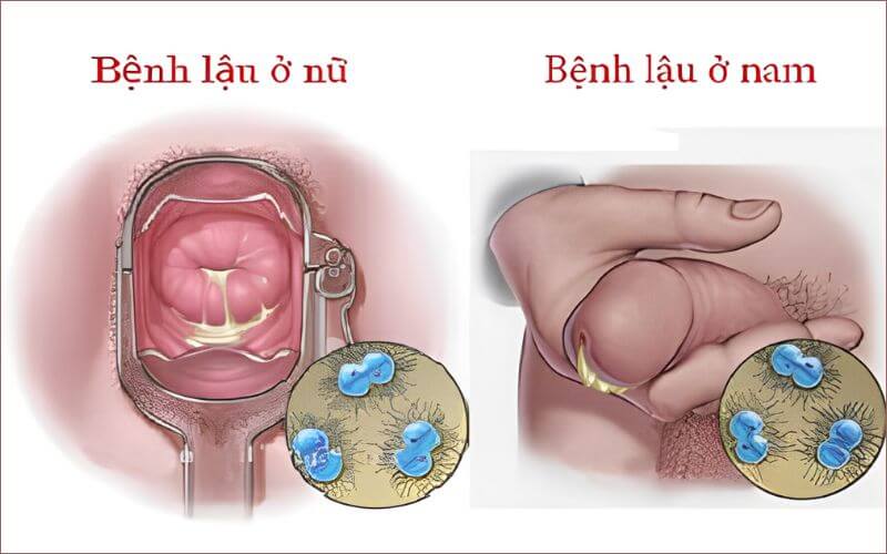 Bệnh lậu có thể gây nhiều biến chứng nguy hiểm ở cả nam giới và nữ giới nếu không được điều trị kịp thời
