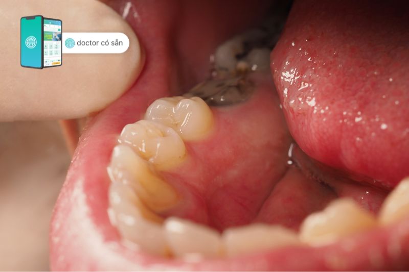 Sâu răng là nguyên nhân phổ biến gây viêm tủy răng