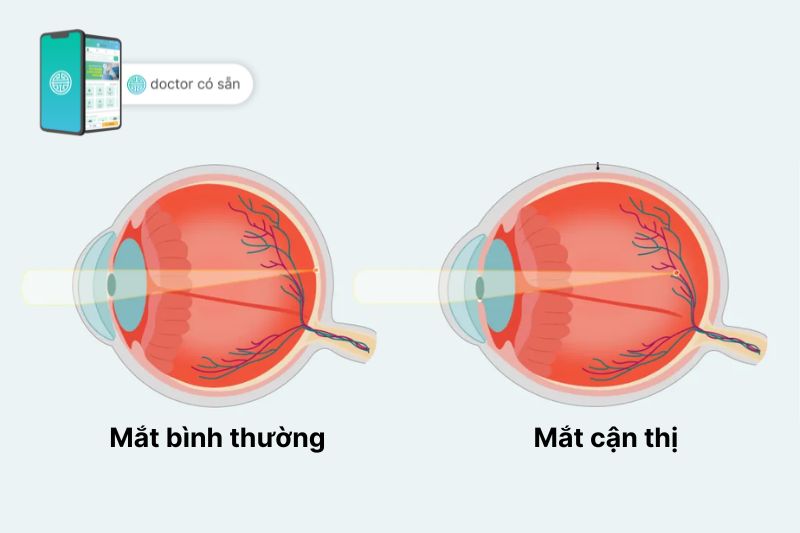 Sự khác nhau về quang học của mắt bình thường và mắt bị cận thị 