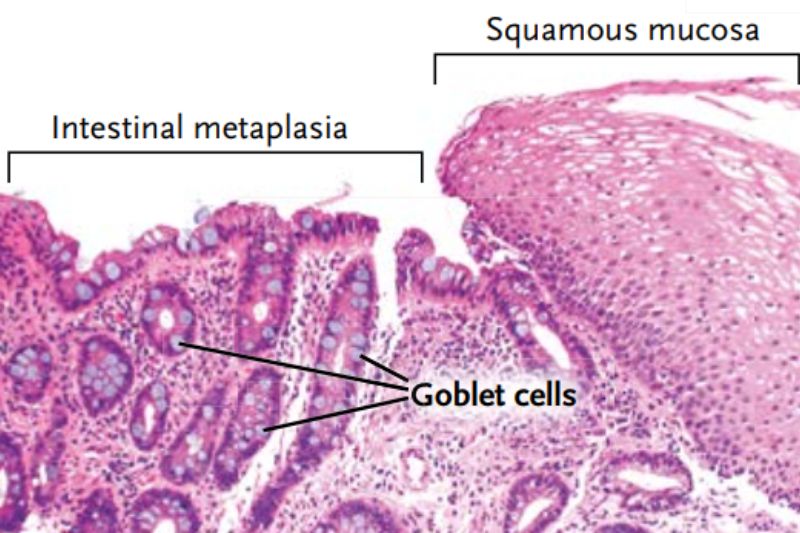 Hiện tượng chuyển sản (metaplasia) trong Barrett thực quản