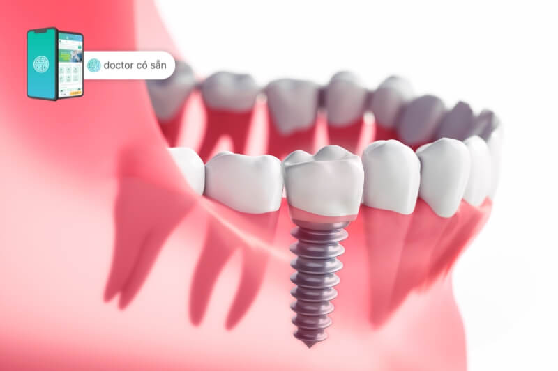 Các biến chứng có thể có của việc ghép nướu răng 