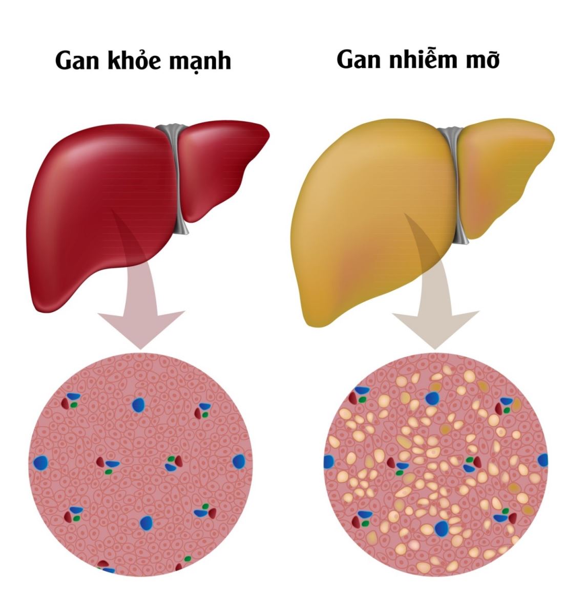 Gan nhiễm mỡ là tình trạng lượng mõ lớn tích tụ trong gan