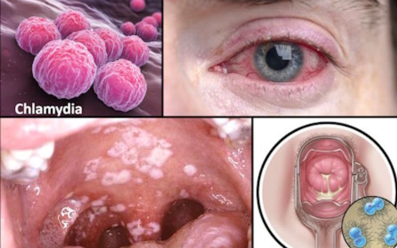 Chlamydia là một trong những bệnh lý STD thường gặp, do vi khuẩn Chlamydia gây ra