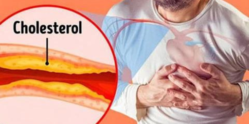 Cholesterol cao gây nhiều biến chứng nguy hiểm cho sức khỏe