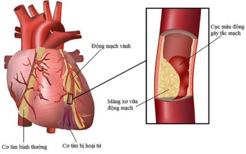 Nguyên nhân xơ vữa động mạch