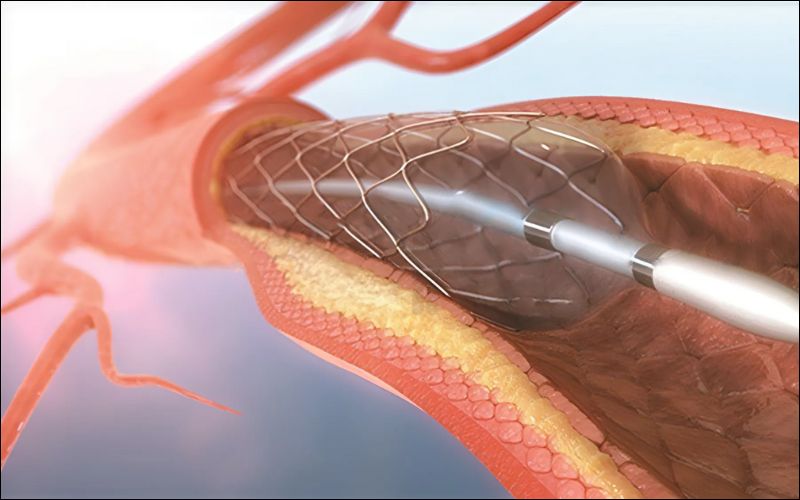 Nong mạch vành và đặt stent để giữ cho động mạch không bị hẹp lại